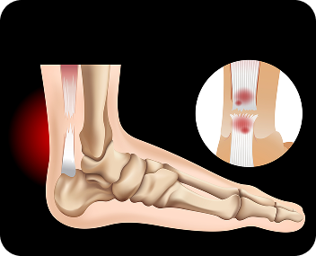 Surgery for Achilles tendon (back of ankle) injuries